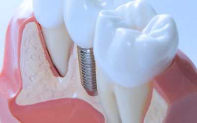 Parcours patient d&rsquo;un Implant dentaire : les étapes en vidéo